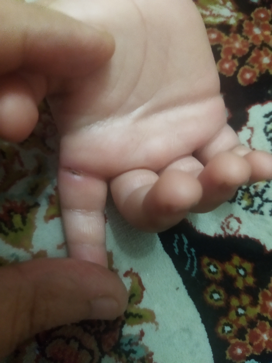 بریدن دست نوزاد و احتمال عفونت