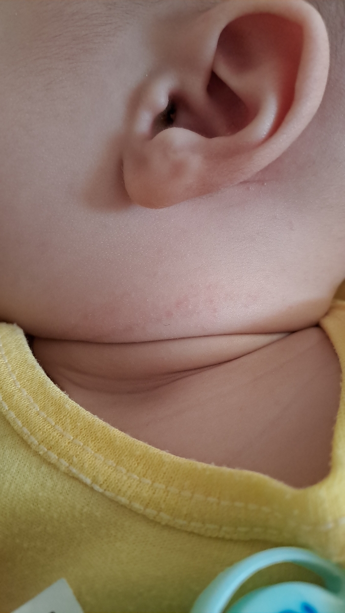 آلرژی و حساسیت به پروتئین گاوی آلرژی و حساسیت به پروتئین گاوی