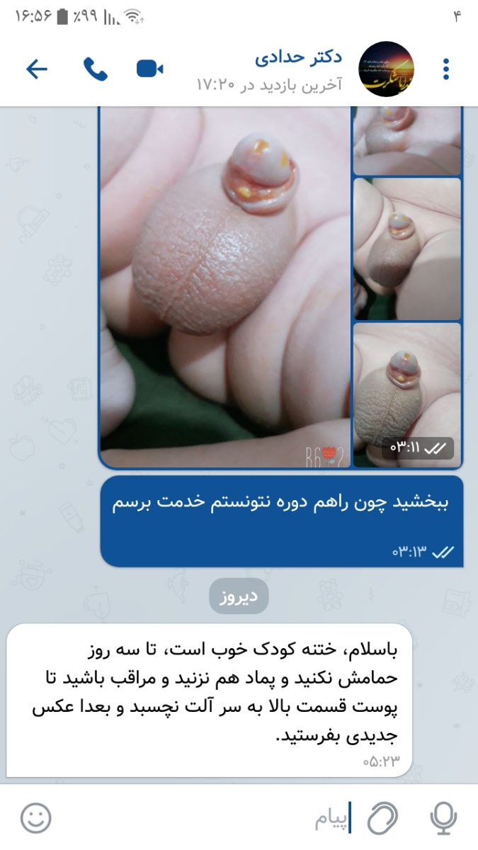 عکس ختنه به روش حلقه گذاشتم،میشه راهنماییم کنین