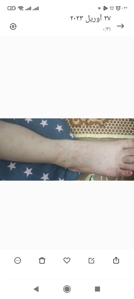 آیا این دونه ها آبله مرغونه؟ آیا این دونه ها آبله مرغونه؟