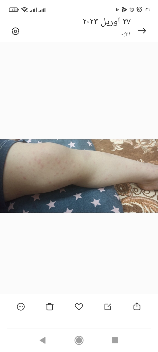 آیا این دونه ها آبله مرغونه؟ آیا این دونه ها آبله مرغونه؟