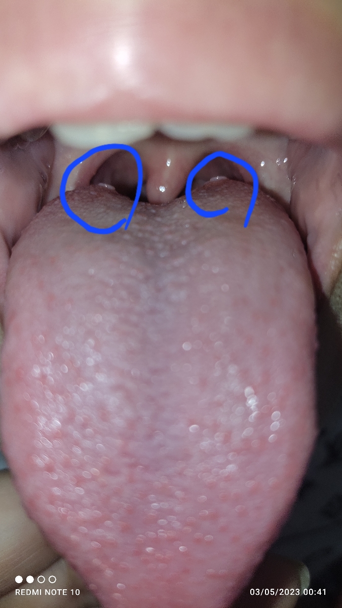 تنگی نفس پسرم و دونه های روی زبونش . میشه زودتر جوابمو بدید😢 تنگی نفس پسرم و دونه های روی زبونش . میشه زودتر جوابمو بدید😢