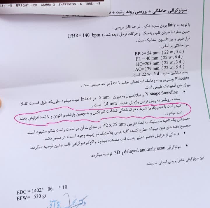 هیدرونفروز کلیه راست جنین هیدرونفروز کلیه راست جنین