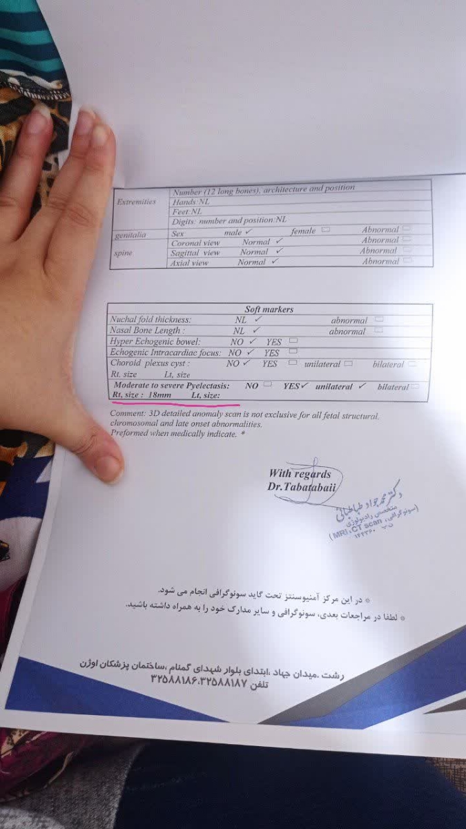 هیدرونفروز کلیه راست جنین هیدرونفروز کلیه راست جنین