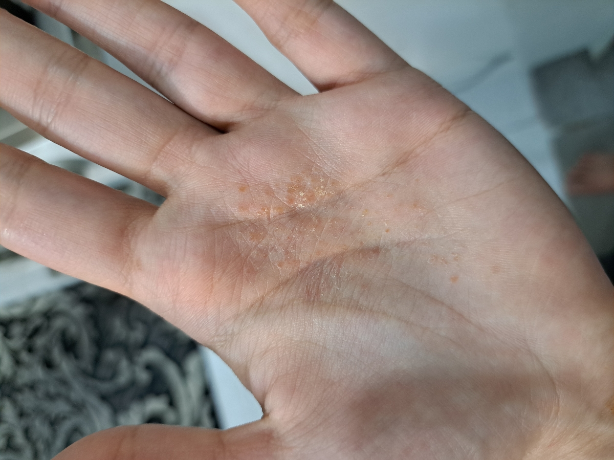 اگزما و دانه در کف دست اگزما و دانه در کف دست