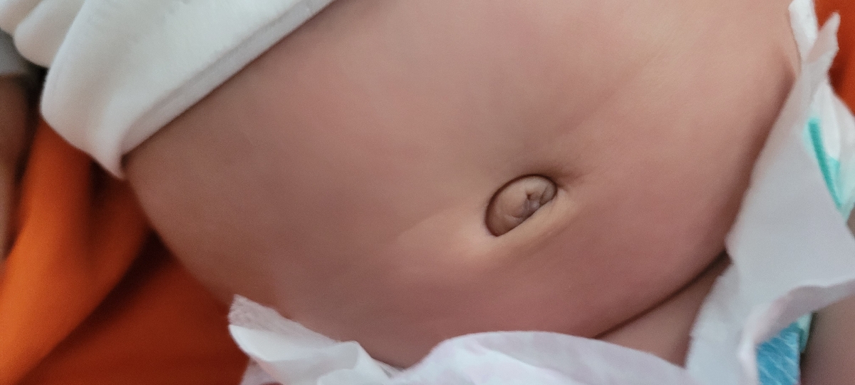 ناف نوزاد ۴۳ روزه