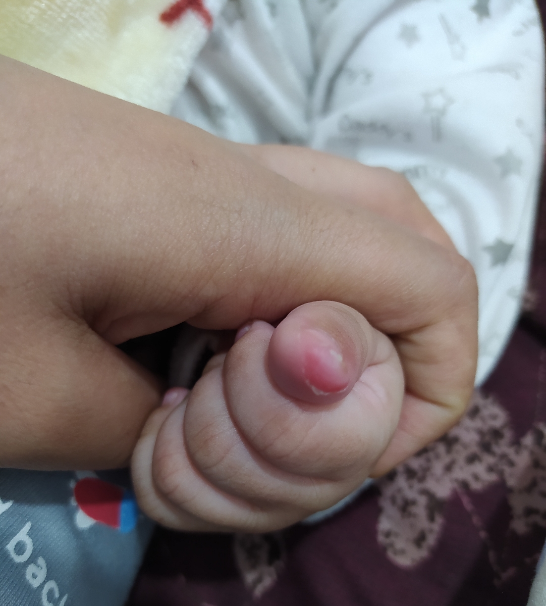 مشکل پوست دست نوزاد چهار ماهه مشکل پوست دست نوزاد چهار ماهه