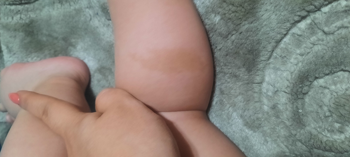 کسی بچش لک قهوه ای کمرنگ روی پوستش داره؟ کسی بچش لک قهوه ای کمرنگ روی پوستش داره؟