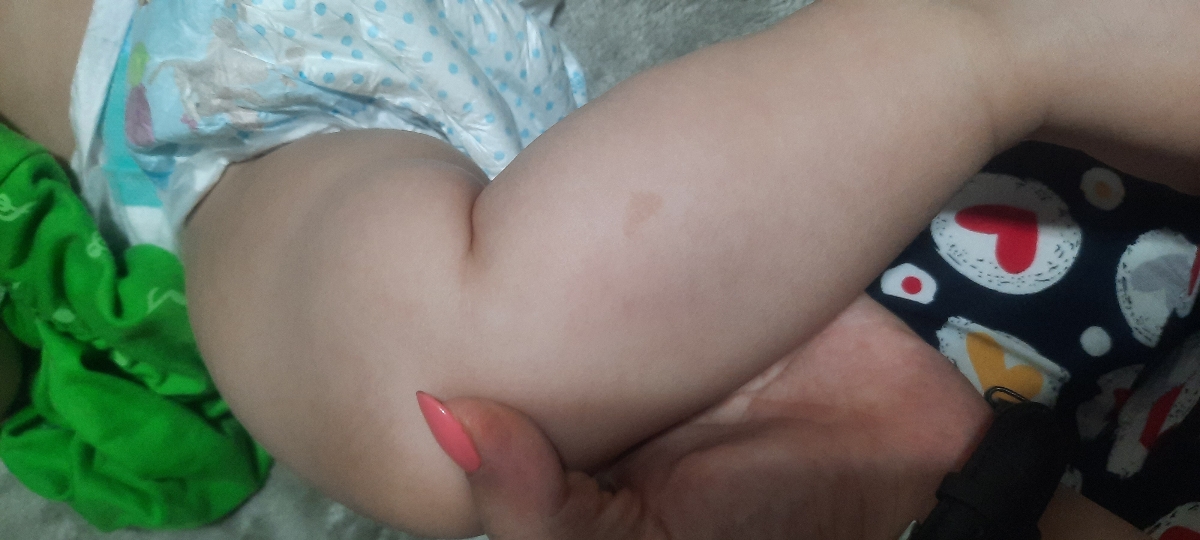 کسی بچش لک قهوه ای کمرنگ روی پوستش داره؟ کسی بچش لک قهوه ای کمرنگ روی پوستش داره؟