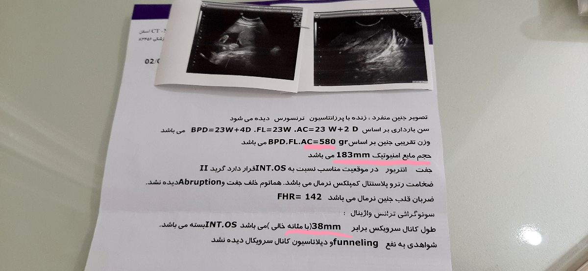 زیاد شدن مایع دور جنین زیاد شدن مایع دور جنین