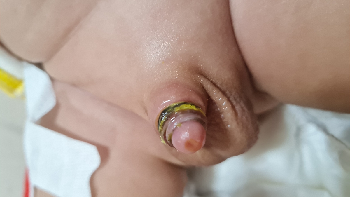 نیوفتادن حلقه بعد از ختنه نیوفتادن حلقه بعد از ختنه