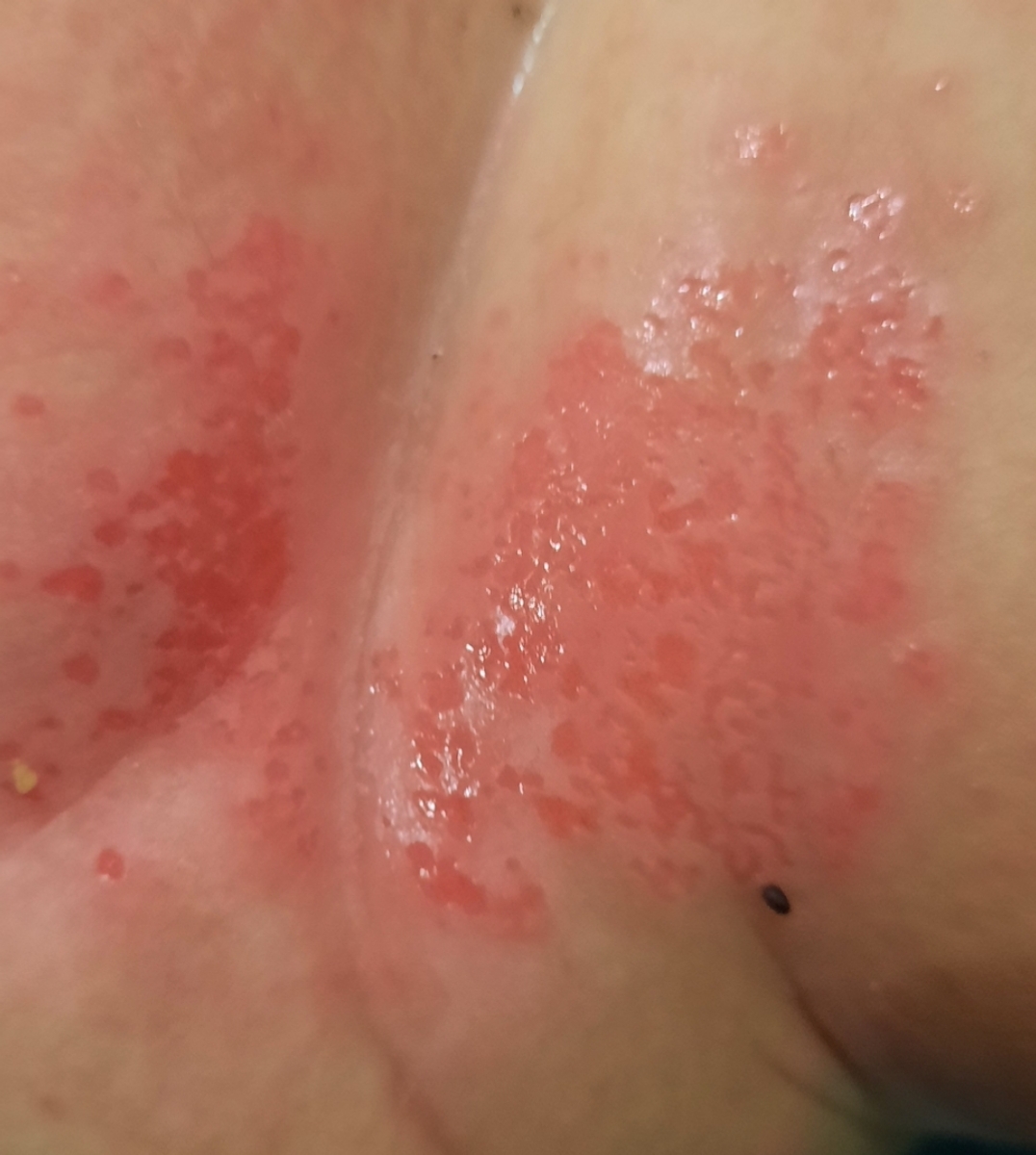 سوختگی پای نوزاد یک ماه و هفده روز سوختگی پای نوزاد یک ماه و هفده روز