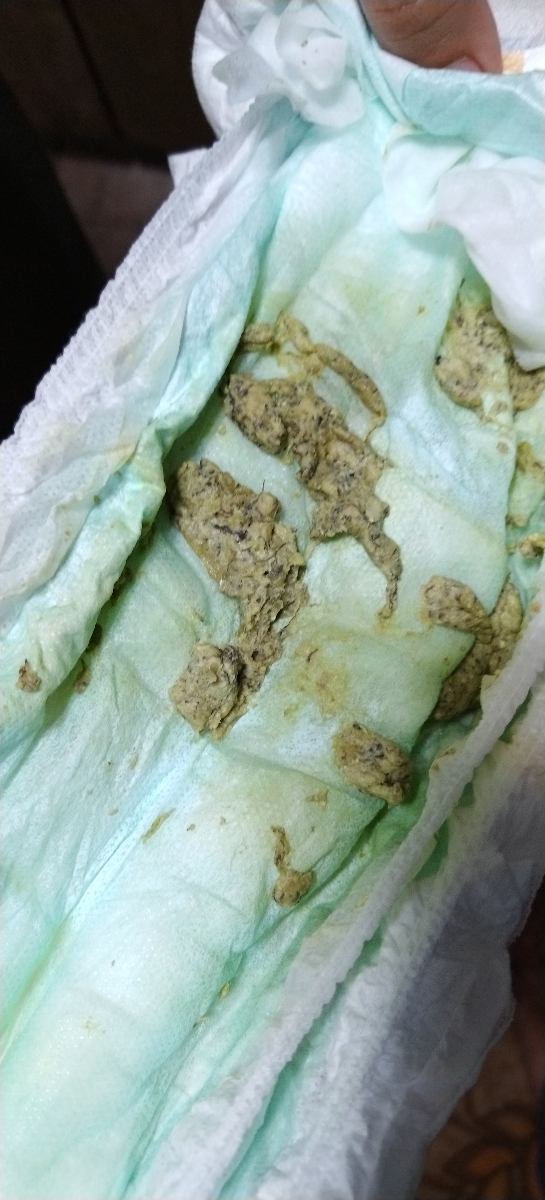 اسهال و مدفوع عجیب کودک 1 سال و 4 ماهه(عکس دارد) اسهال و مدفوع عجیب کودک 1 سال و 4 ماهه(عکس دارد)