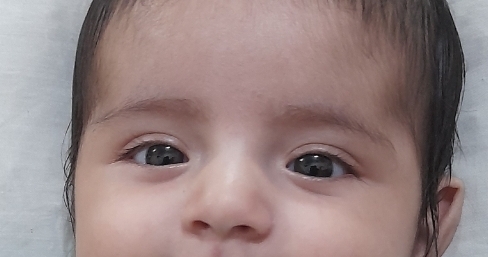 کوچیک شدن چشم نوزاد