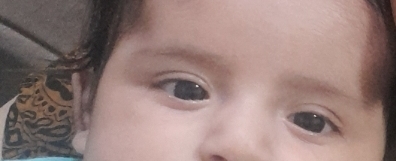 کوچیک شدن چشم نوزاد