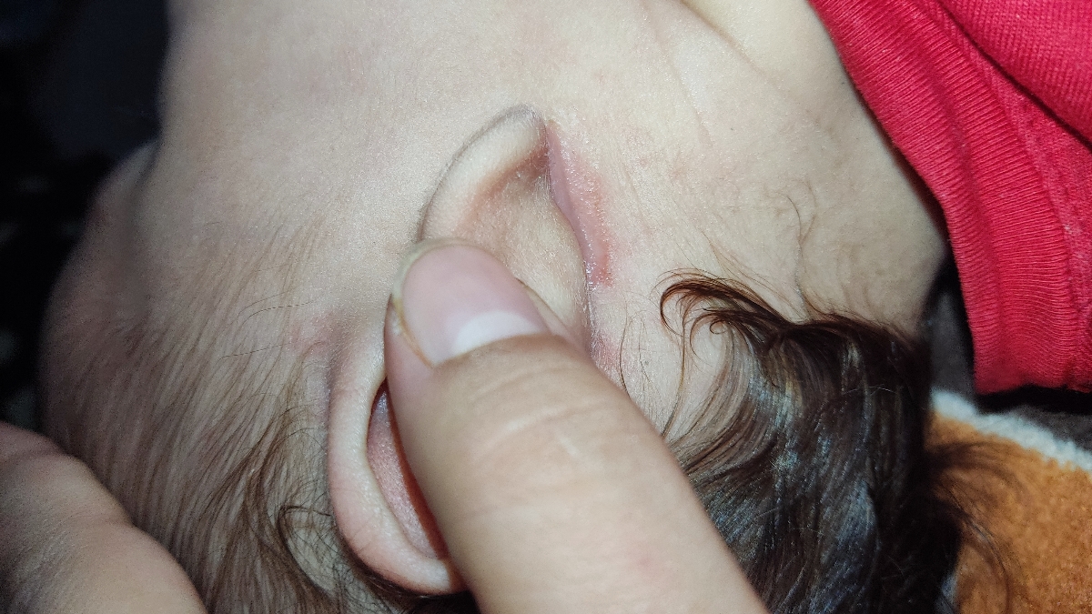 خارش و خشکی پشت گوش نوزاد + عکس خارش و خشکی پشت گوش نوزاد + عکس