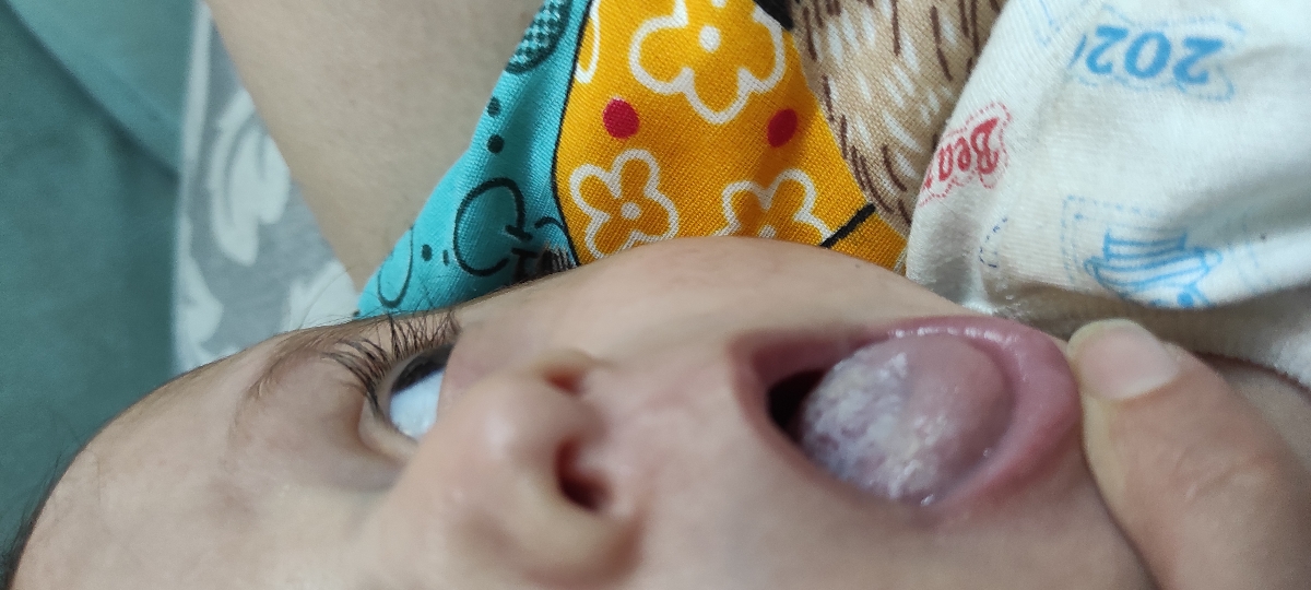 علت برفک روی زبان نوزاد ؟؟ علت برفک روی زبان نوزاد ؟؟