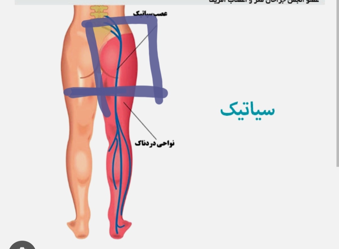 گرفتن سیاتیک در بارداری