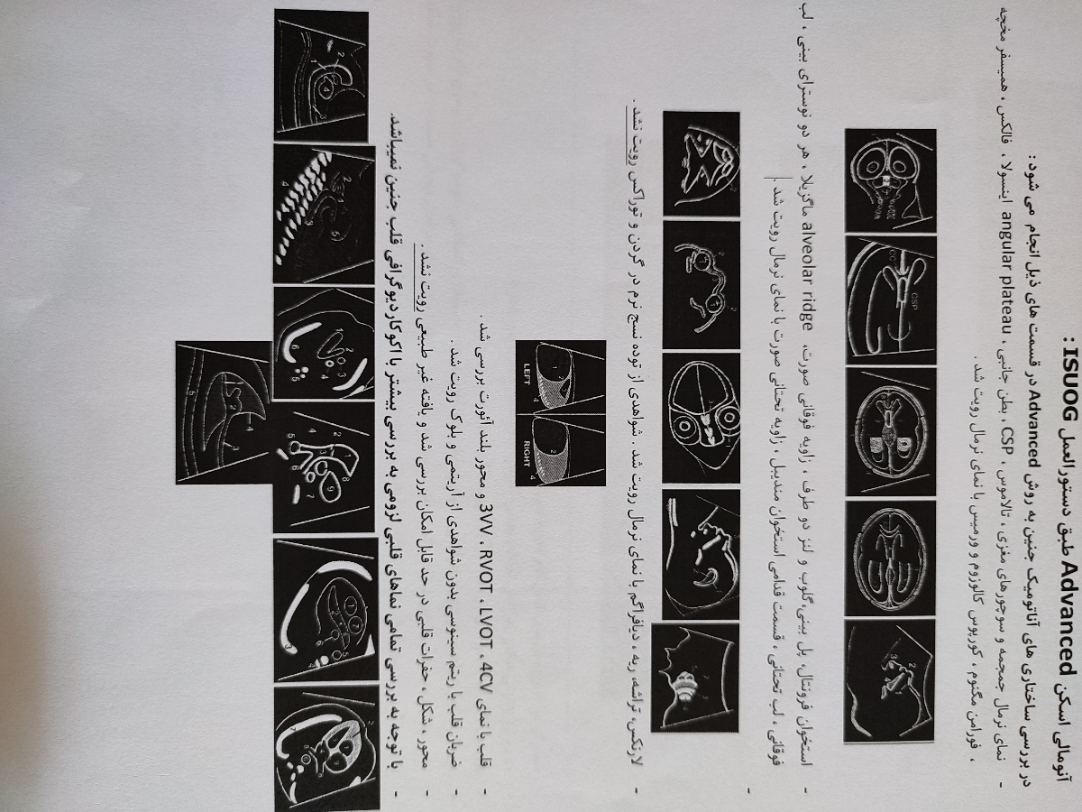 تفسیر سونوی غربالگری دوم