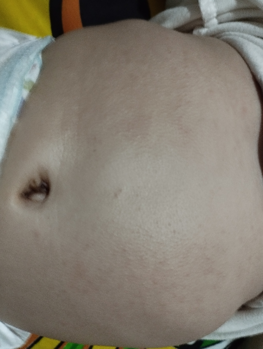 شروع غذا کمکی و حساسیت به آرد برنج شروع غذا کمکی و حساسیت به آرد برنج