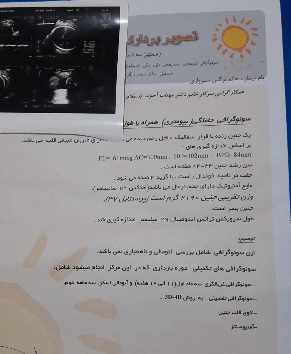 هماتوم ساب کورنیک در ساک بارداری هماتوم ساب کورنیک در ساک بارداری