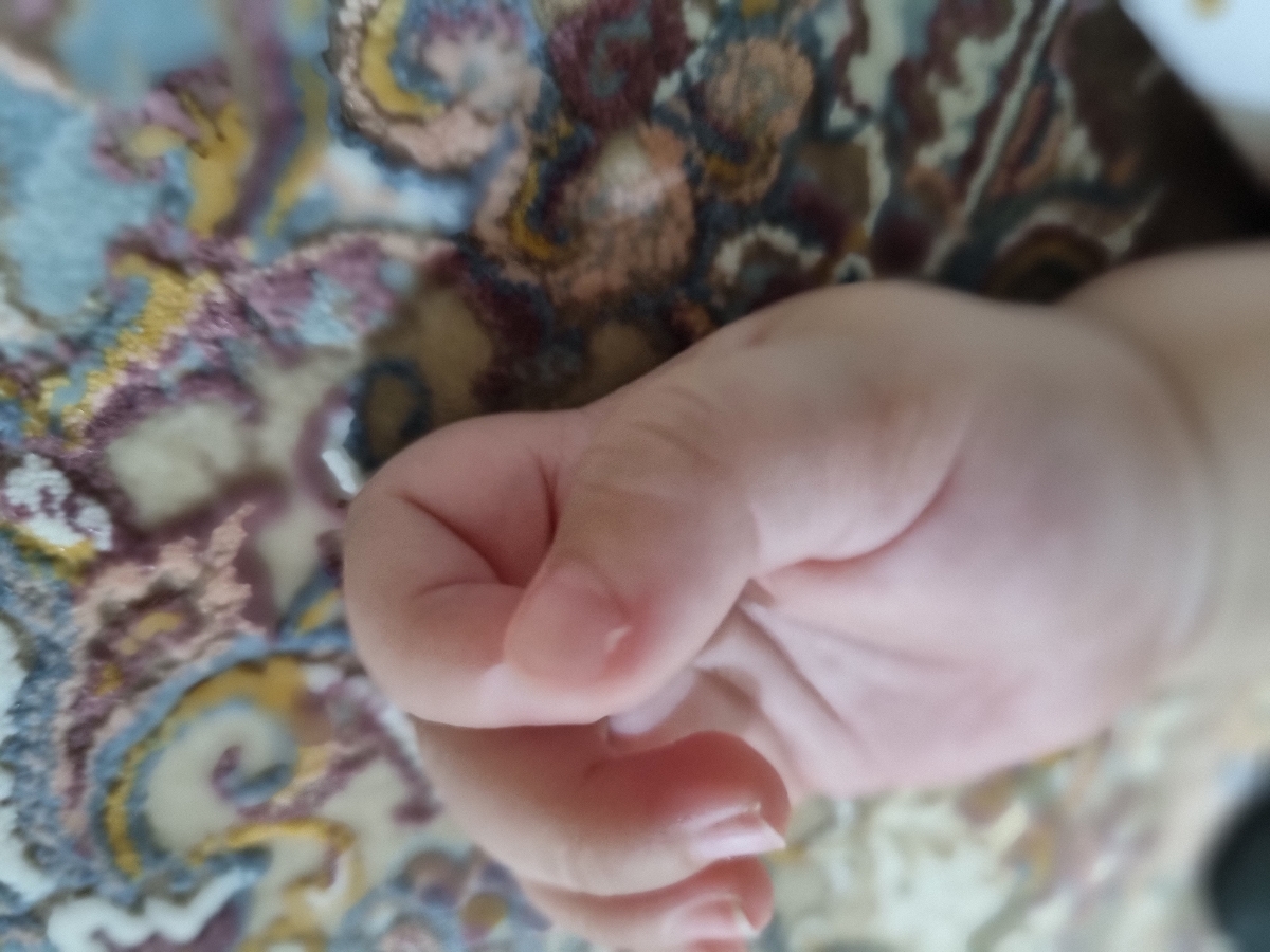 ریشه ای شدن دور ناخن دختر۷ماهه ریشه ای شدن دور ناخن دختر۷ماهه