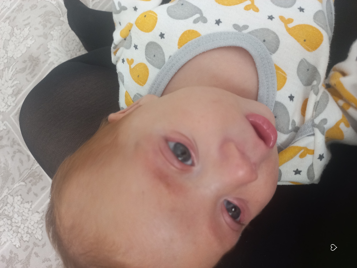 علت قرمزی چشم نوزاد ؟