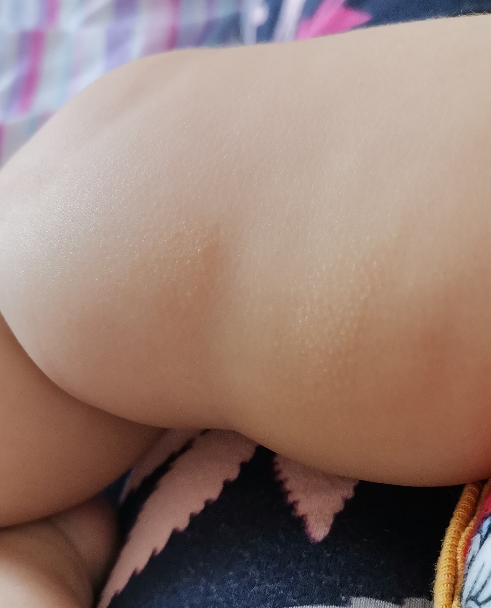 خشکی یک ناحیه از پوست
