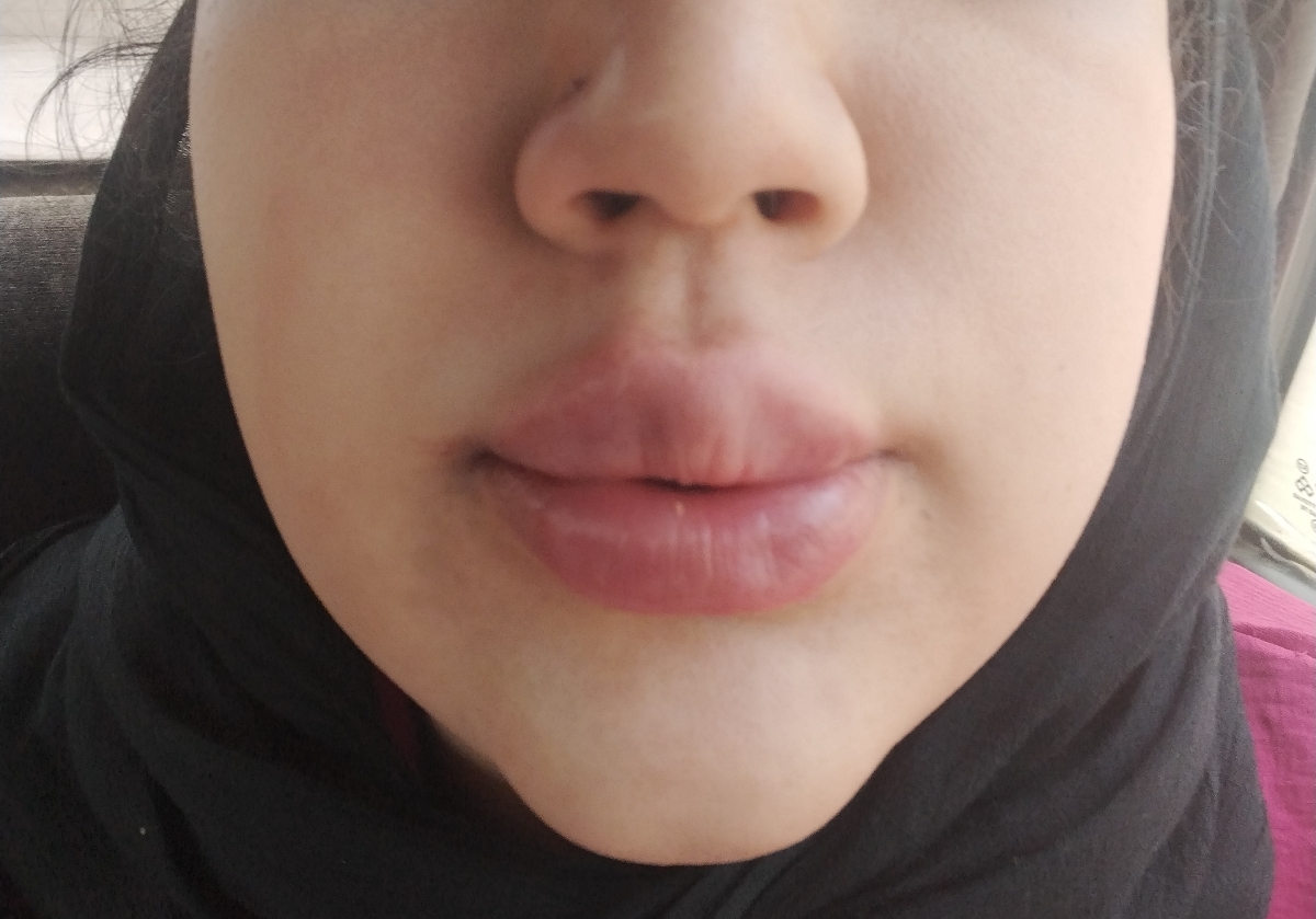 در مورد ژل لب😱 در مورد ژل لب😱
