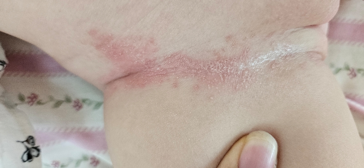 ادرار سوختگی پای نوزاد دختر ادرار سوختگی پای نوزاد دختر