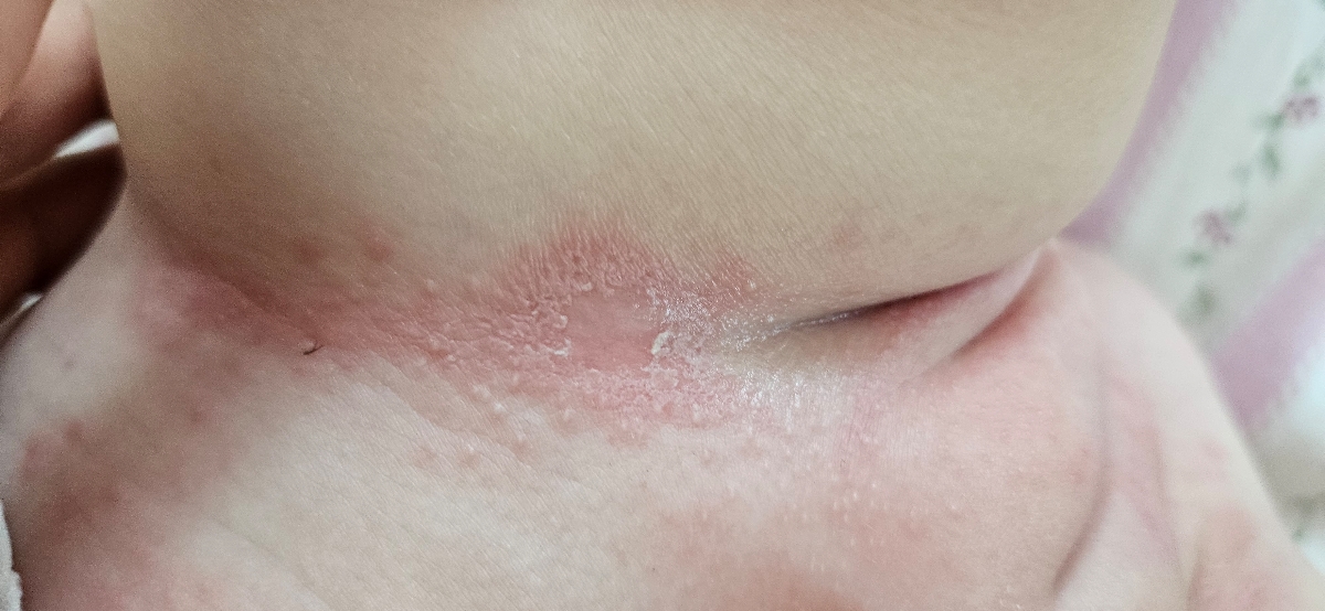 ادرار سوختگی پای نوزاد دختر ادرار سوختگی پای نوزاد دختر