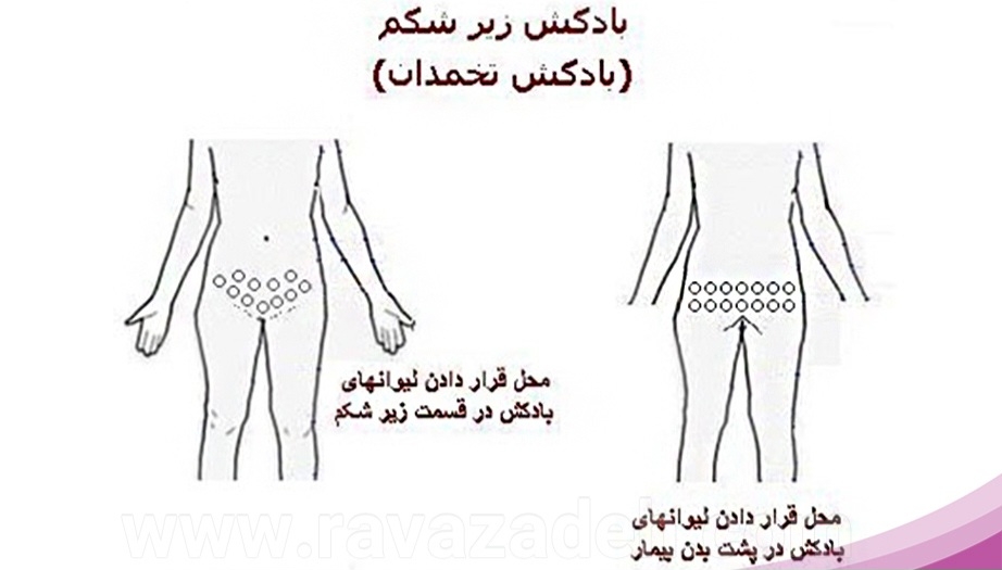 بادکش رحم برای بعد از سقط یا دفع بقایا و پولیپ بادکش رحم برای بعد از سقط یا دفع بقایا و پولیپ