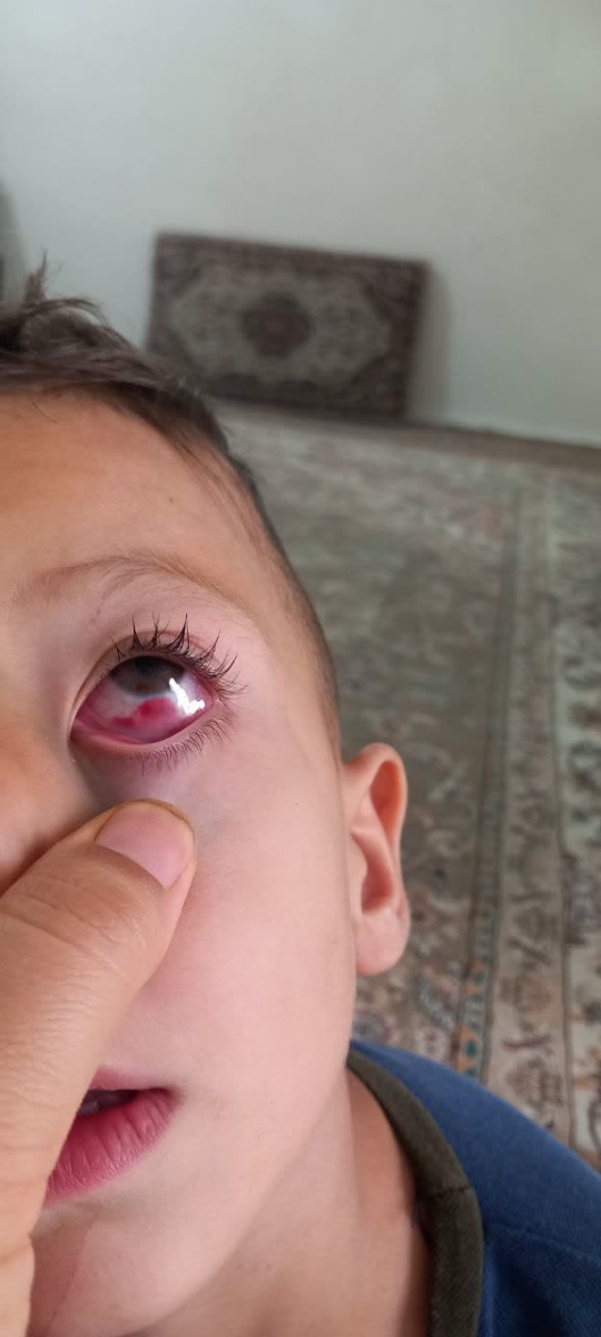 ضربه به چشم کودک ضربه به چشم کودک