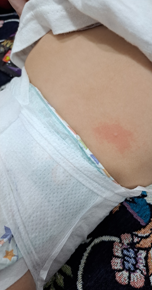قرمزی پوست بچه قرمزی پوست بچه