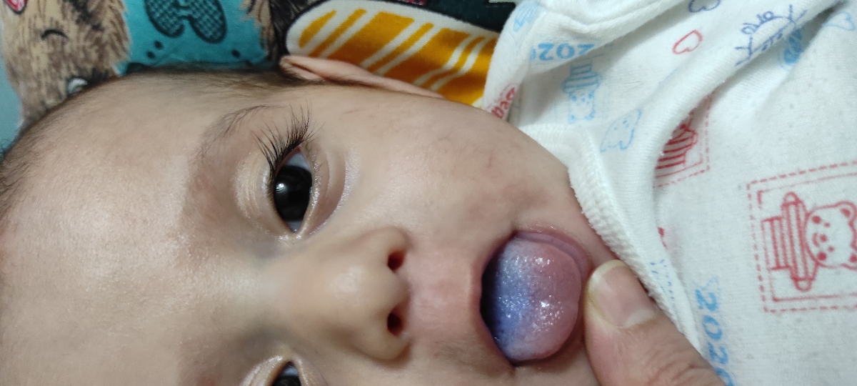 علت برفک روی زبان نوزاد ؟؟ علت برفک روی زبان نوزاد ؟؟