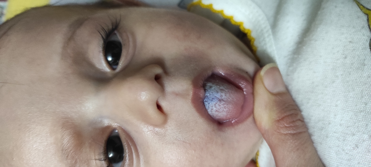 علت برفک روی زبان نوزاد ؟؟ علت برفک روی زبان نوزاد ؟؟