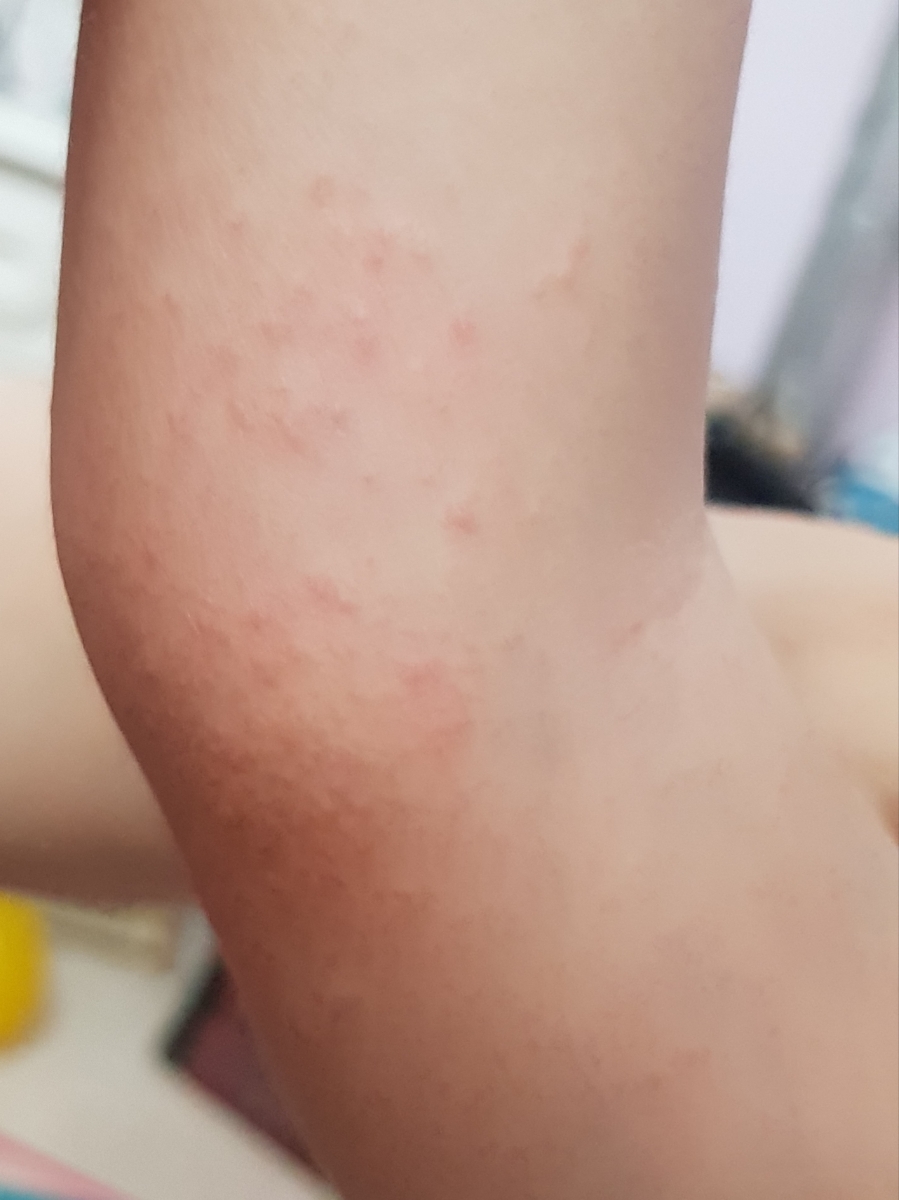 اگزما پوستی و خارش