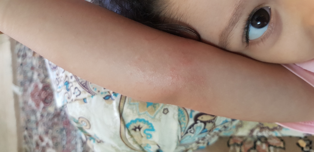 اگزما پوستی و خارش
