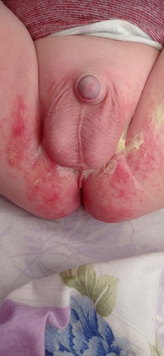 دکتر سوختگی شدید پای نوزاد ۱۰ماهه دکتر سوختگی شدید پای نوزاد ۱۰ماهه