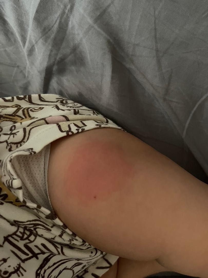 ابسه کردن واکسن ۶ ماهگی ابسه کردن واکسن ۶ ماهگی