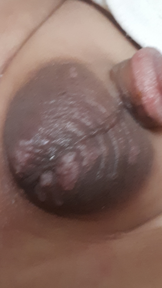 علت وجود ضایعات پوستی روی بیضه شیرخوار علت وجود ضایعات پوستی روی بیضه شیرخوار