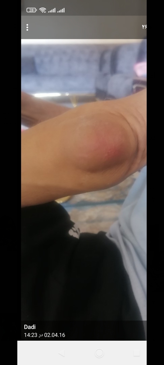علت ورم آرنج دست پدرم