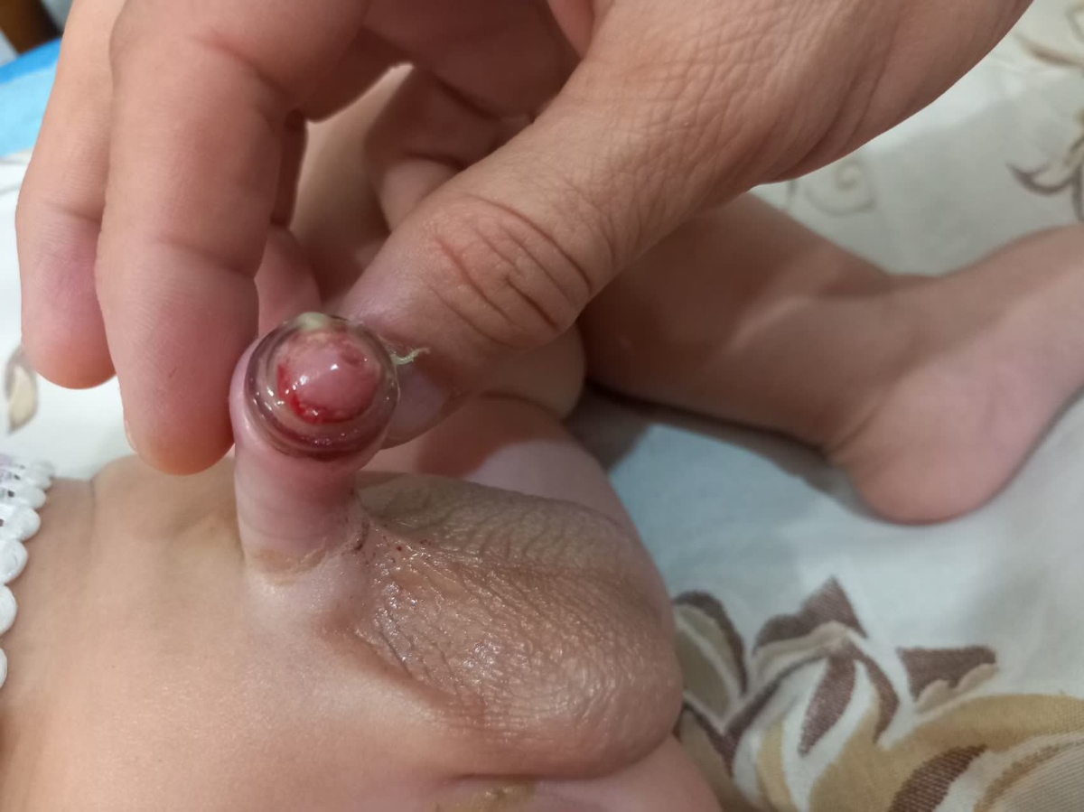 سلام پزشک اوما و دوستانم سوالم در رابطه با ختنه حلقه هست(عکس) سلام پزشک اوما و دوستانم سوالم در رابطه با ختنه حلقه هست(عکس)