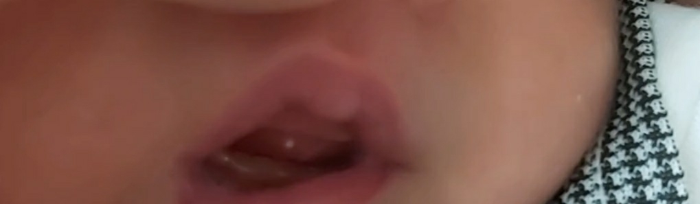 آفت دهان نوزاد۱۵ روزه آفت دهان نوزاد۱۵ روزه