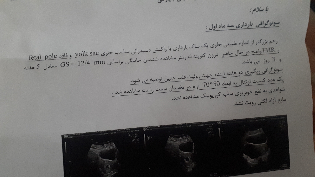 کیست لوتئال در بارداری کیست لوتئال در بارداری
