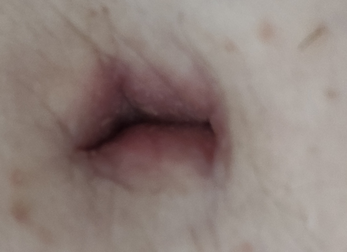 خارش و قرمزی داخل ناف خارش و قرمزی داخل ناف