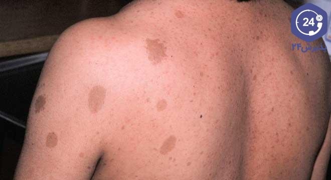 لک قهوای پوستی زیر بغل