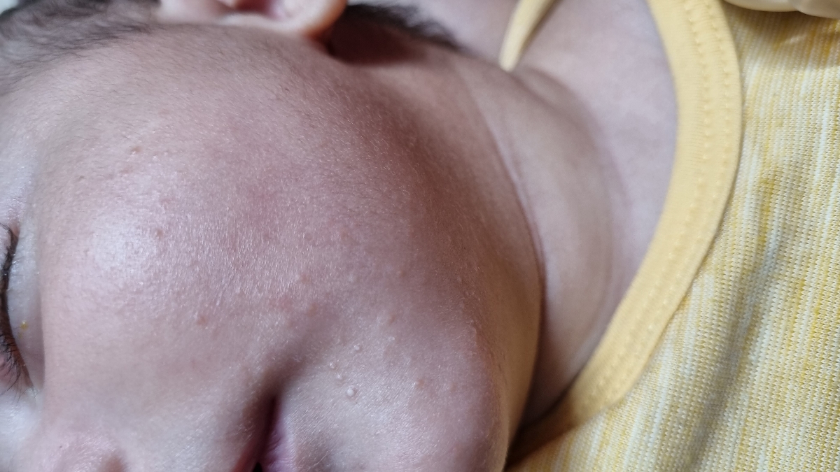 جوش صورت نوزاد ۲ماهه جوش صورت نوزاد ۲ماهه
