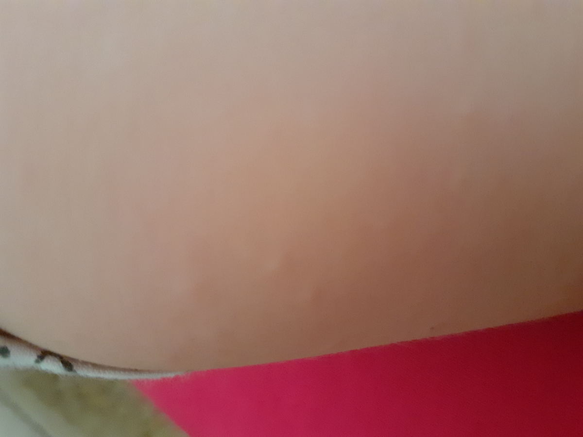 دونه های ریز برجسته بیشتر در قسمت ران و ساق و چندتا در دست... دونه های ریز برجسته بیشتر در قسمت ران و ساق و چندتا در دست...