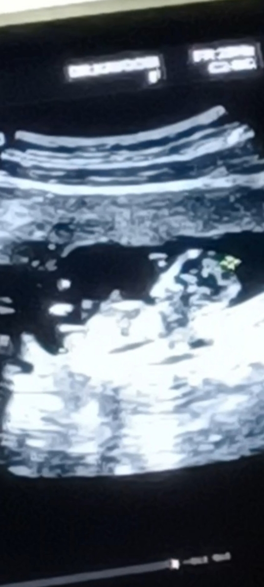 سلام جواب ازمایش غربالگری اول❤️